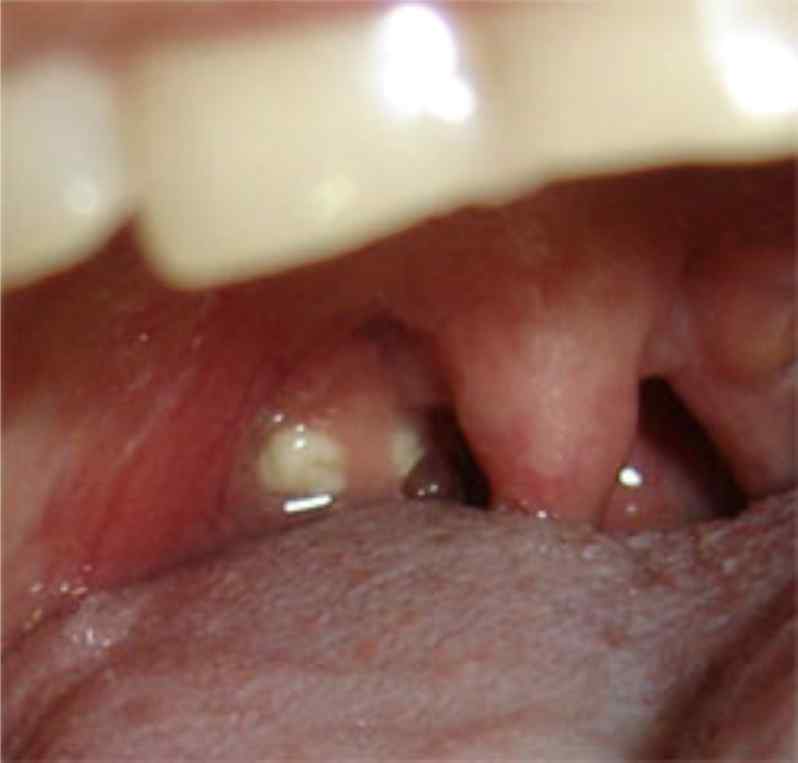 Caseum: conheça os sintomas das bolinhas na garganta